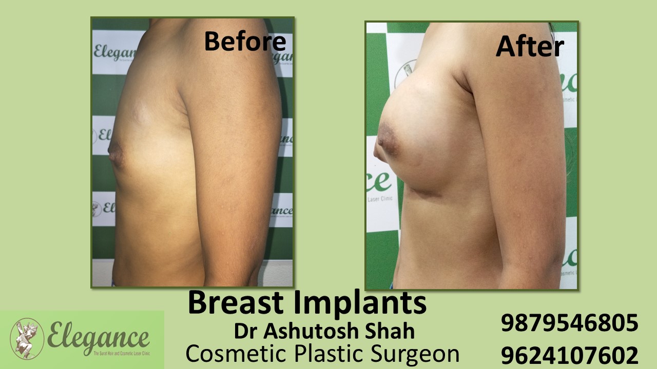 Small Breast Increase Treatment in Vesu, Adajan, Olpad, Surat