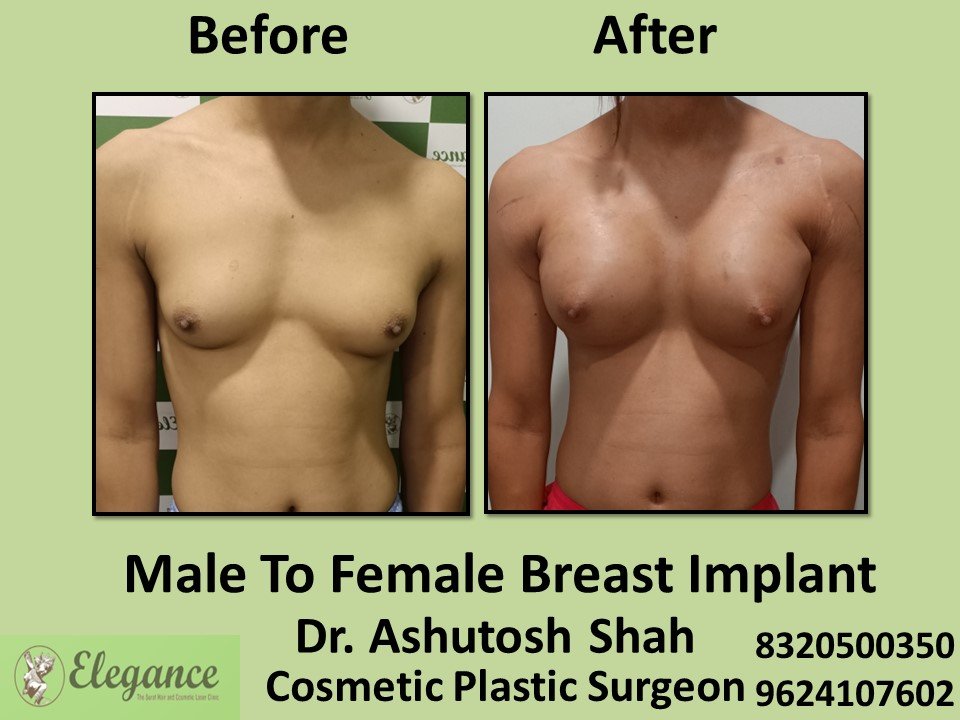 man female breast implants 