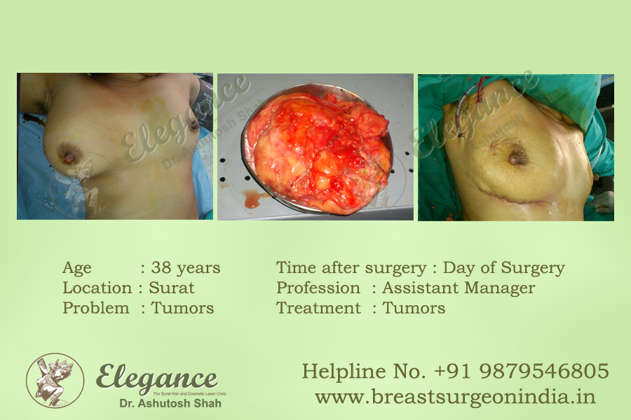Post Breast Cancer (Mastectomy Reconstruction) in Surat, Gujarat (India)