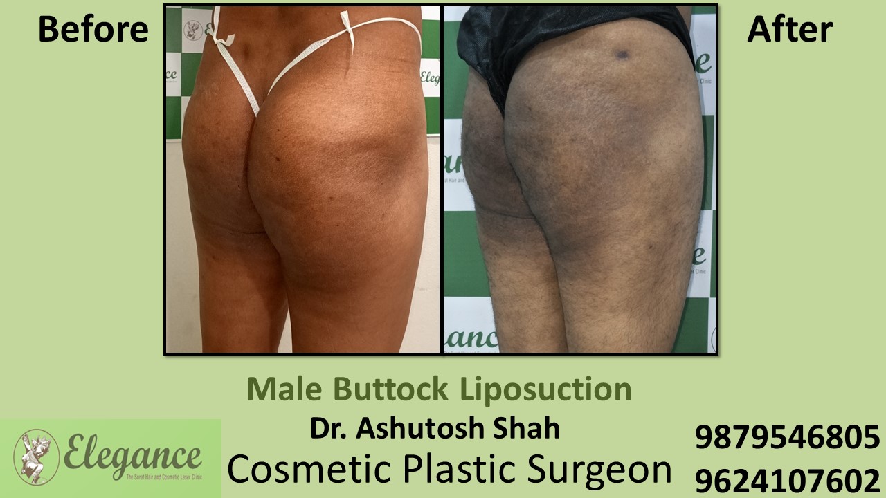 Buttocks Liposuction Treatment in Bharuch, Gujarat, India.