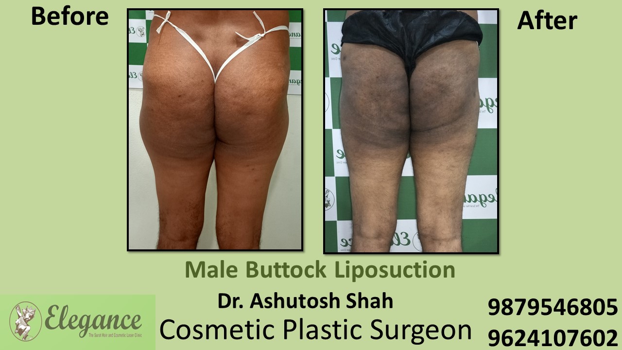 Buttocks Liposuction Treatment in Surat, Gujarat, India.