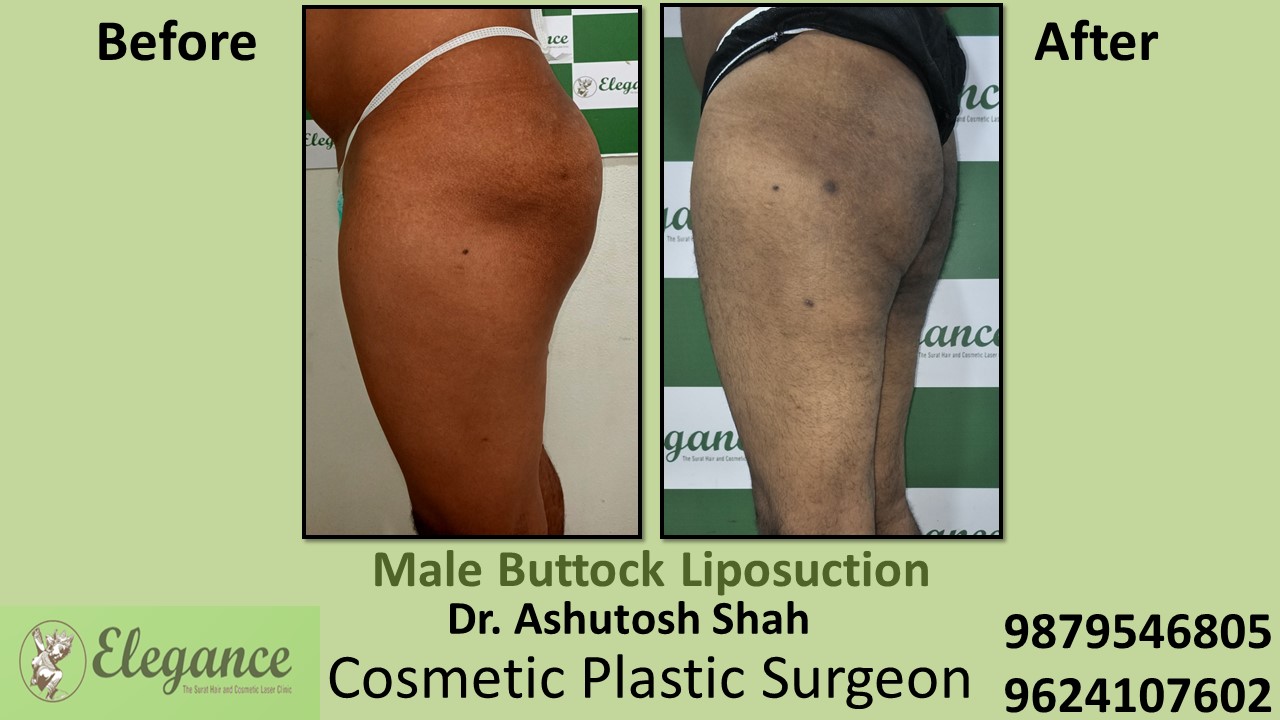 Buttocks Liposuction Treatment in Vadodara, Gujarat, India.