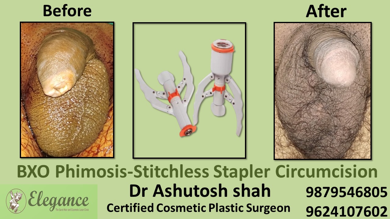 BXO Phimosis-Stitchless Stapler Circumcision in Surat
