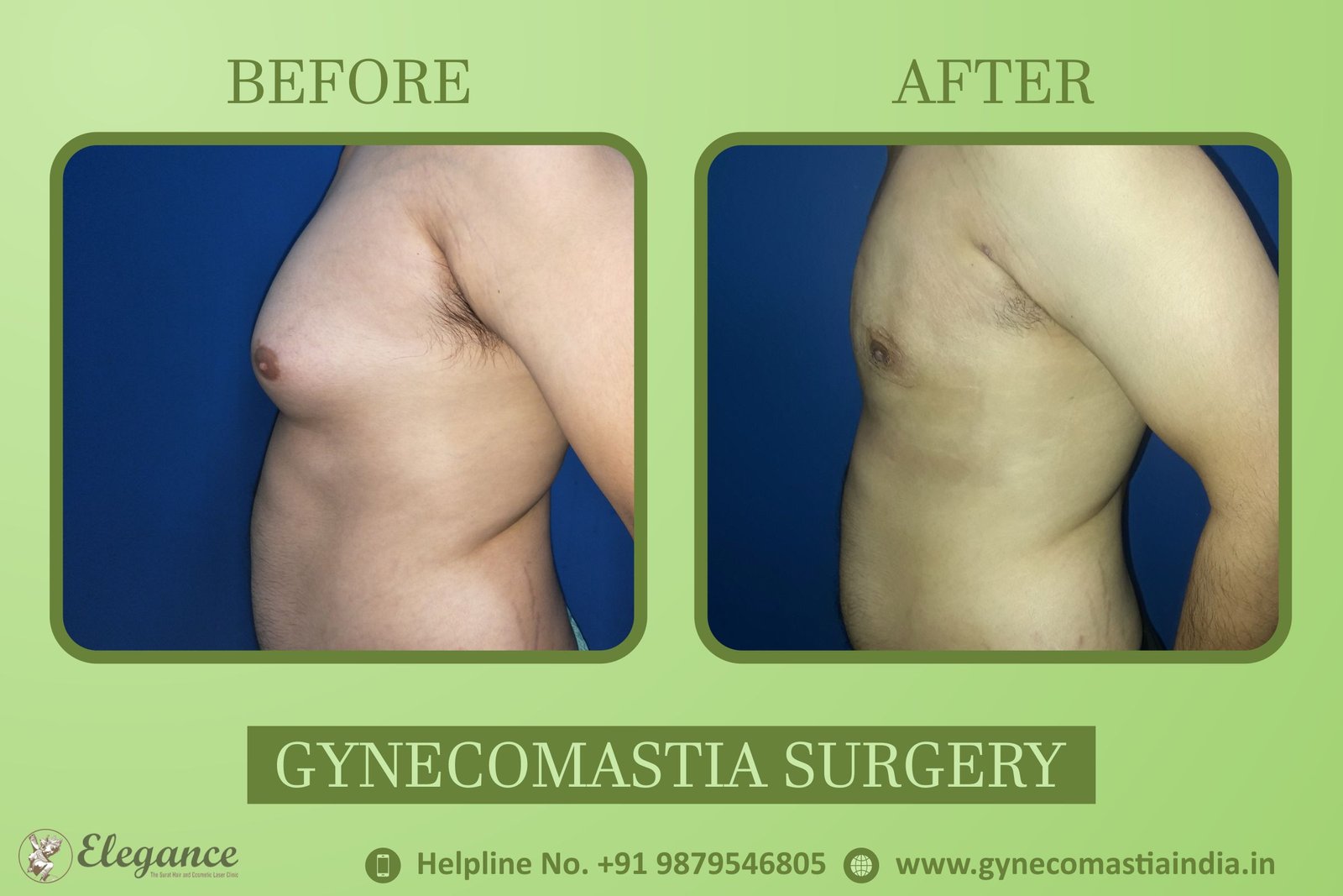 Gynecomastia Procedure Bardoli, Gujarat, india