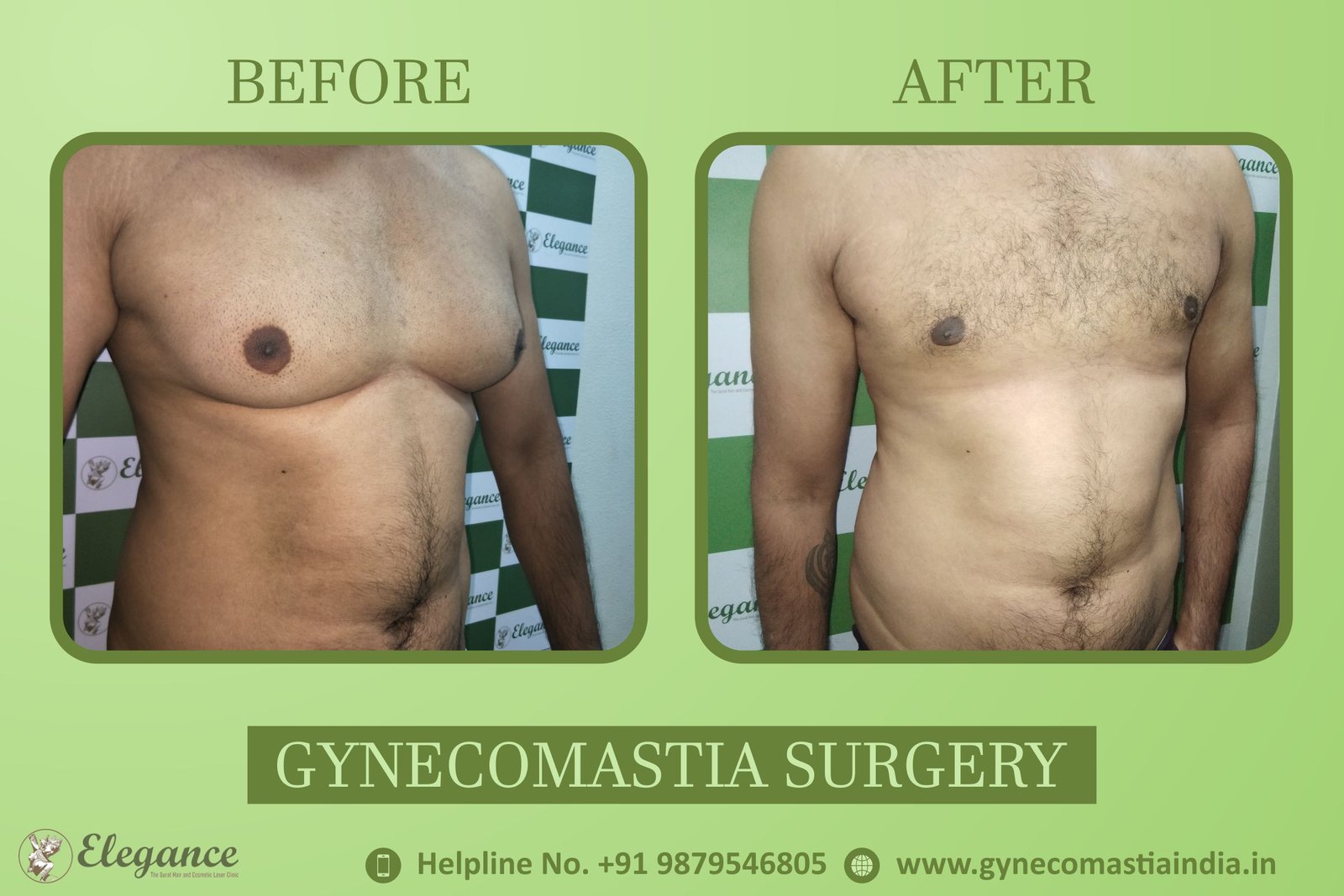 Gynecomastia Clinic in Ankleswar, Gujarat, india