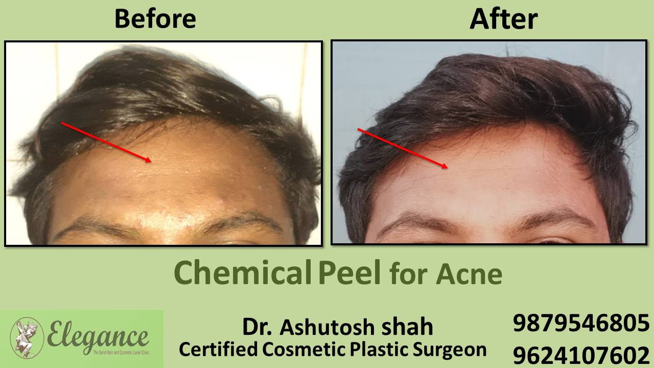 Chemical Peel for Acne, Ankleshwar, Gujarat, India.