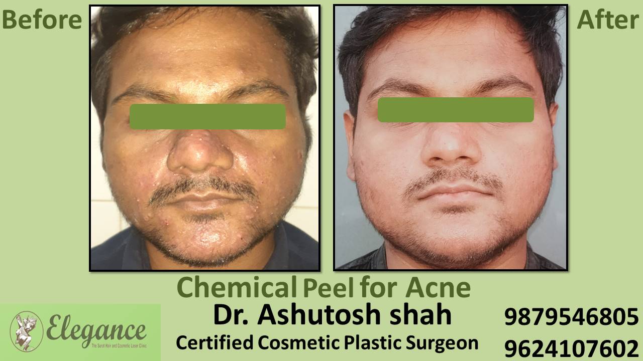 Chemical Peel for Acne, Bharuch, Gujarat, India.