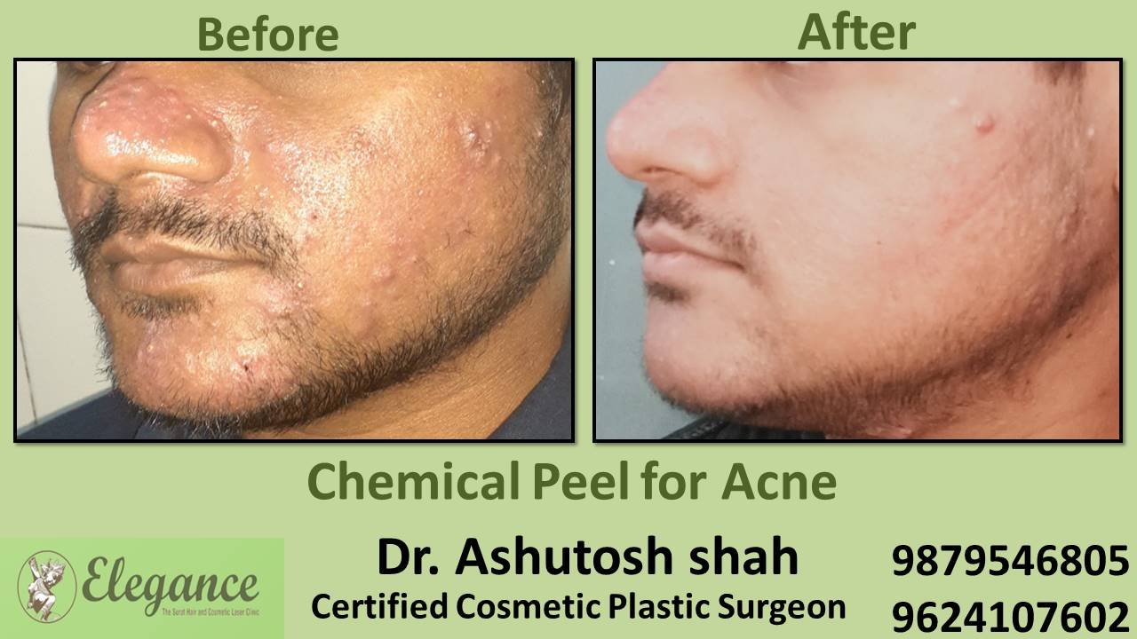 Chemical Peel for Acne, Hazira, Gujarat, India.