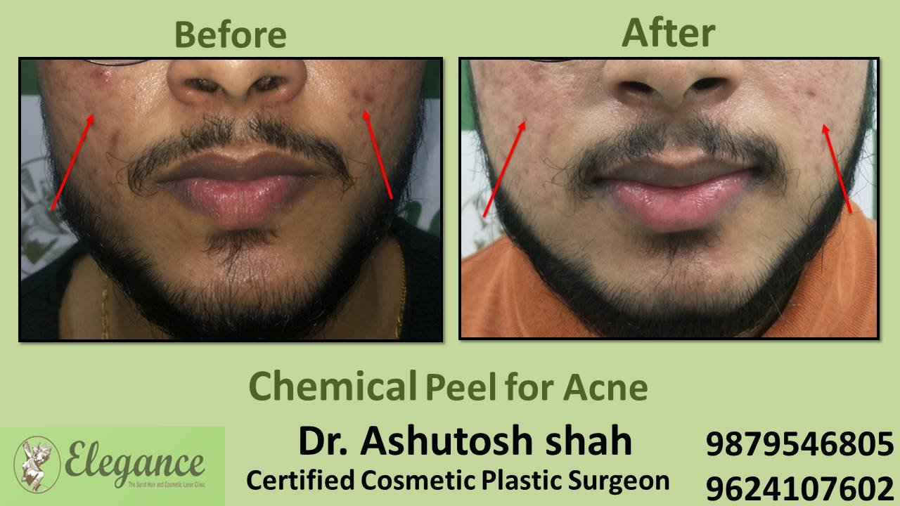 Chemical Peel for Acne, Kosamba, Gujarat, India.