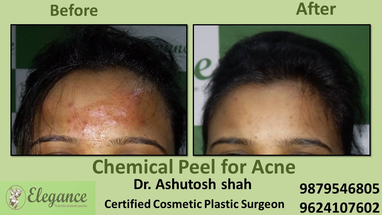 Chemical Peel for Acne, Selvasa, Gujarat, India.