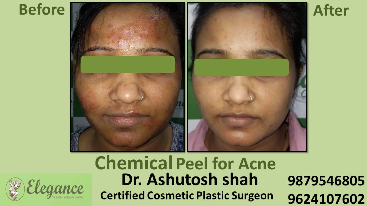 Chemical Peel for Acne, Surat, Gujarat, India.