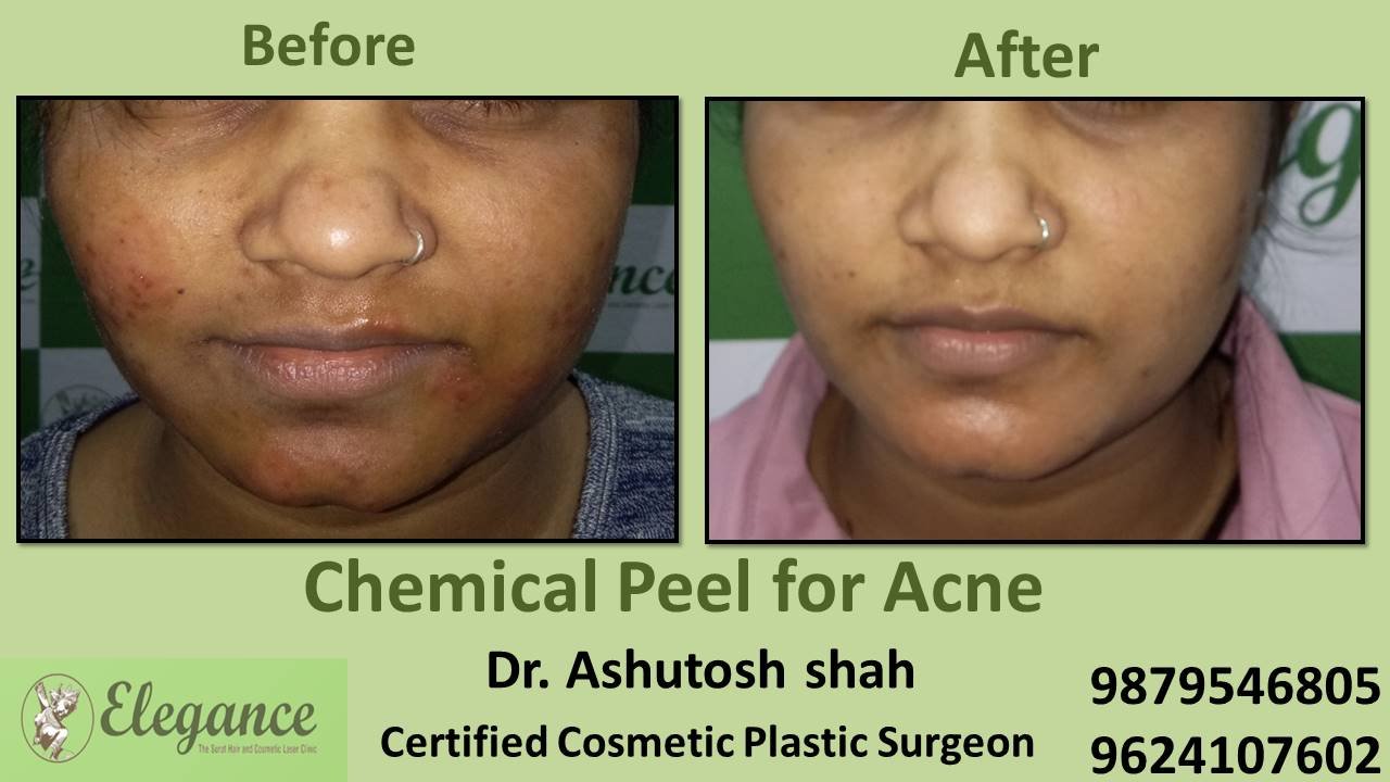 Chemical Peel for Acne, Valsad, Gujarat, India.