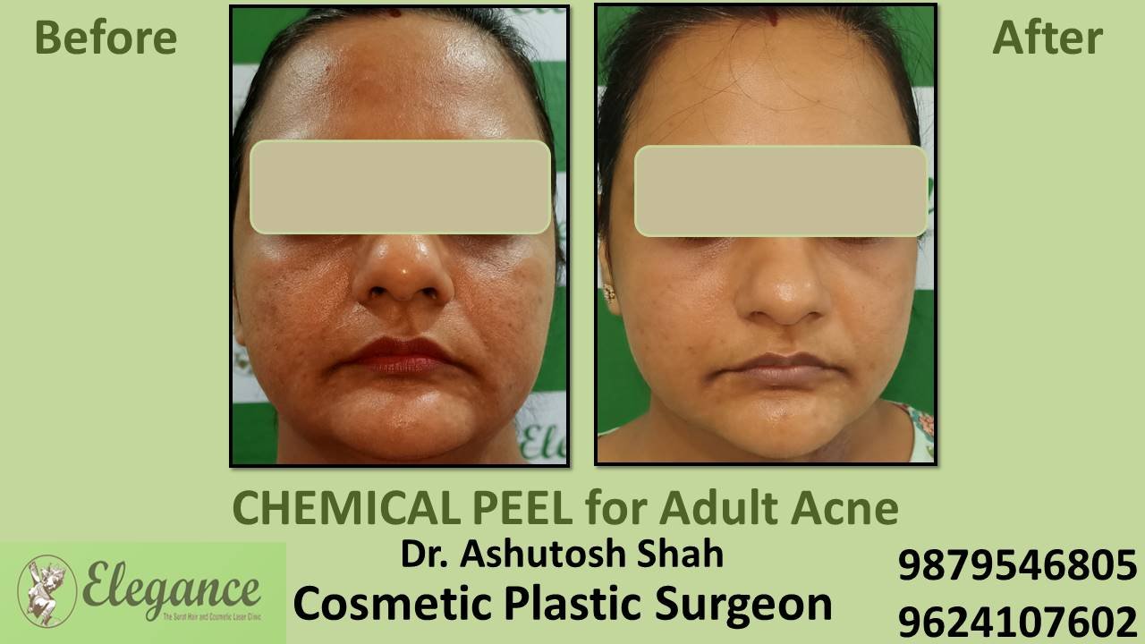 Chemical Peeling Cost in Mangrol, Gujarat, India.