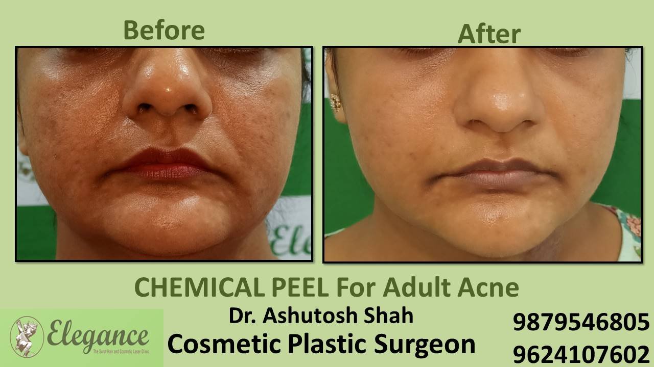 Chemical Peeloff Cost in Chikhli, Gujarat, India.