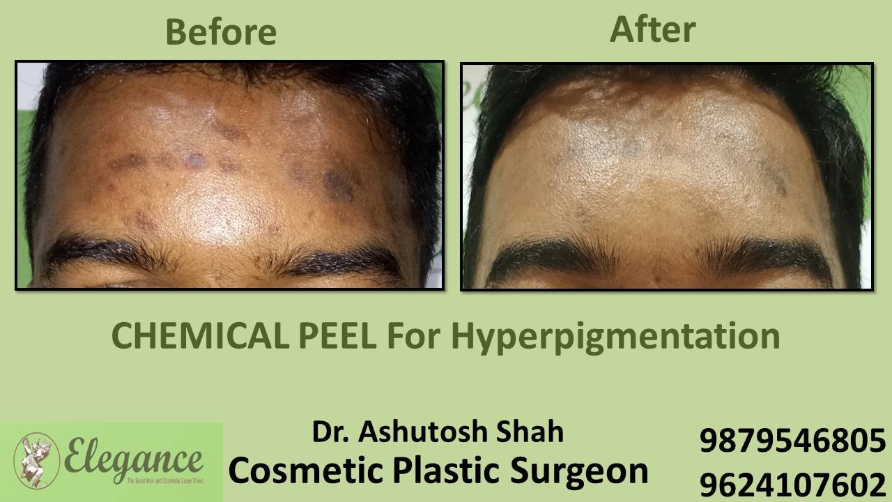 Chemical Peeloff Cost in Kosamba, Gujarat, India.