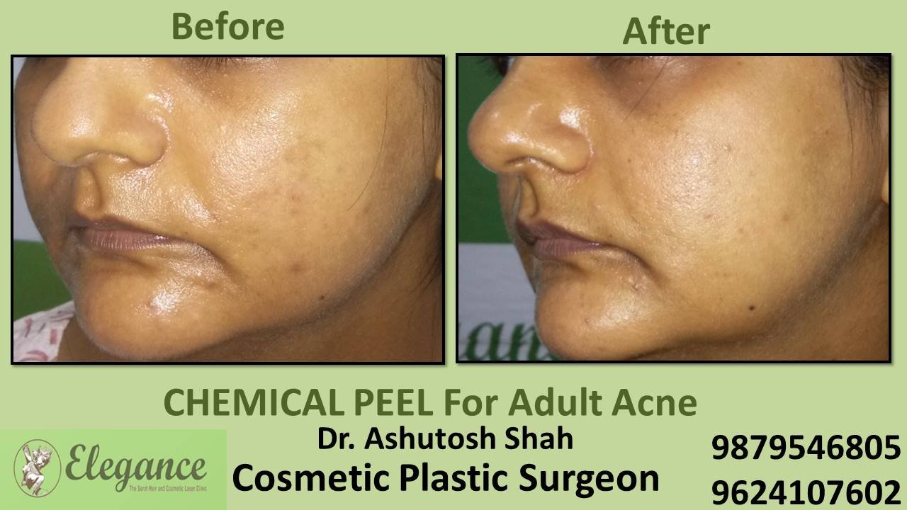 Chemical Peeloff Cost in Valsad, Gujarat, India.