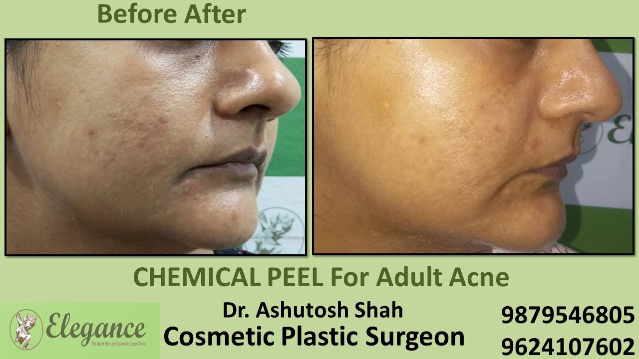 Chemical Peeloff Cost in Vapi, Gujarat, India.