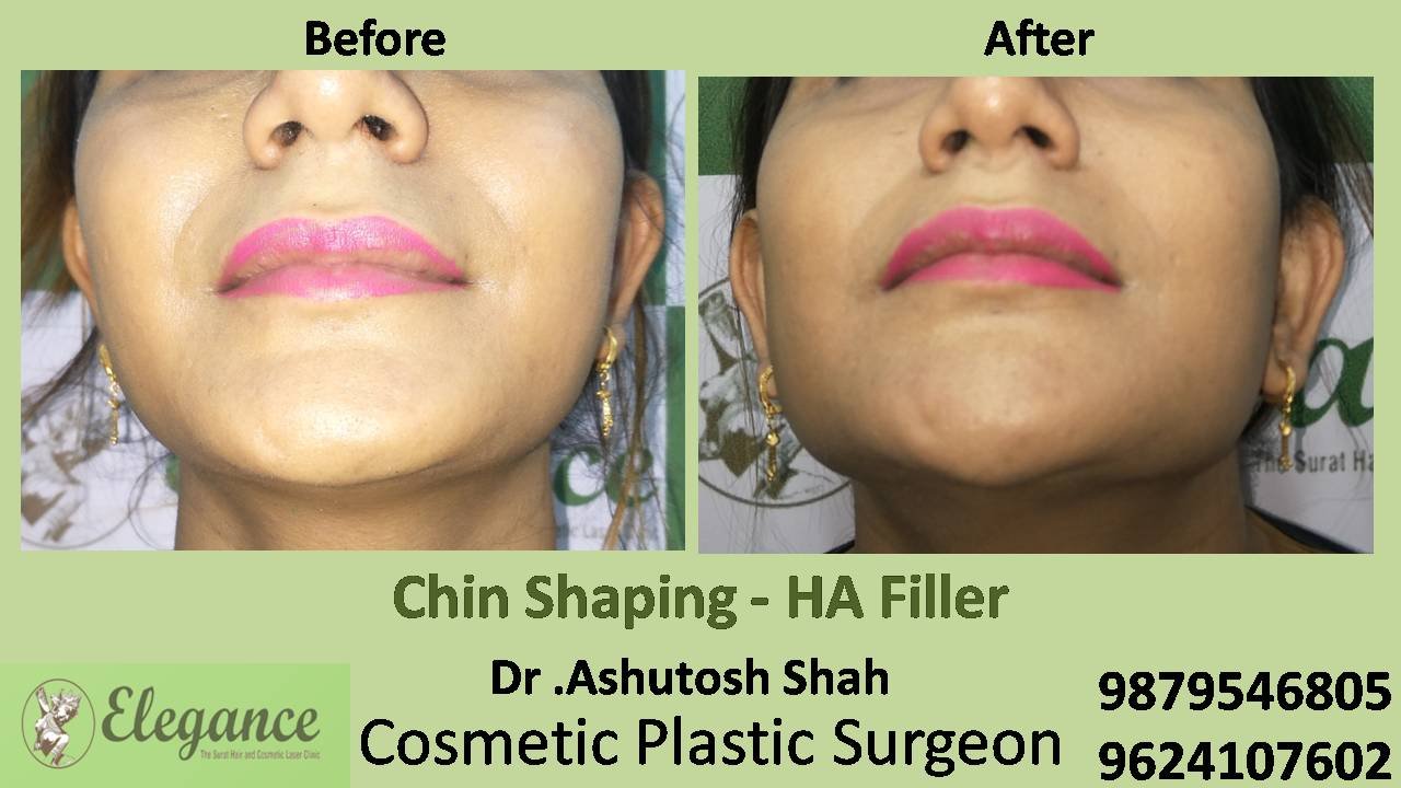 Chin & Cheek Augmentation In Surat, Gujarat (India)