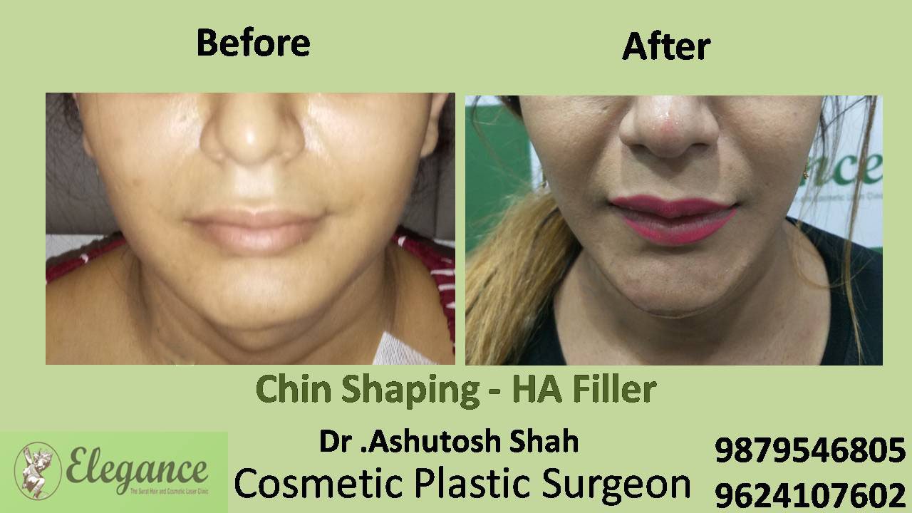 Chin & Cheek Augmentation In Surat, Gujarat (India)