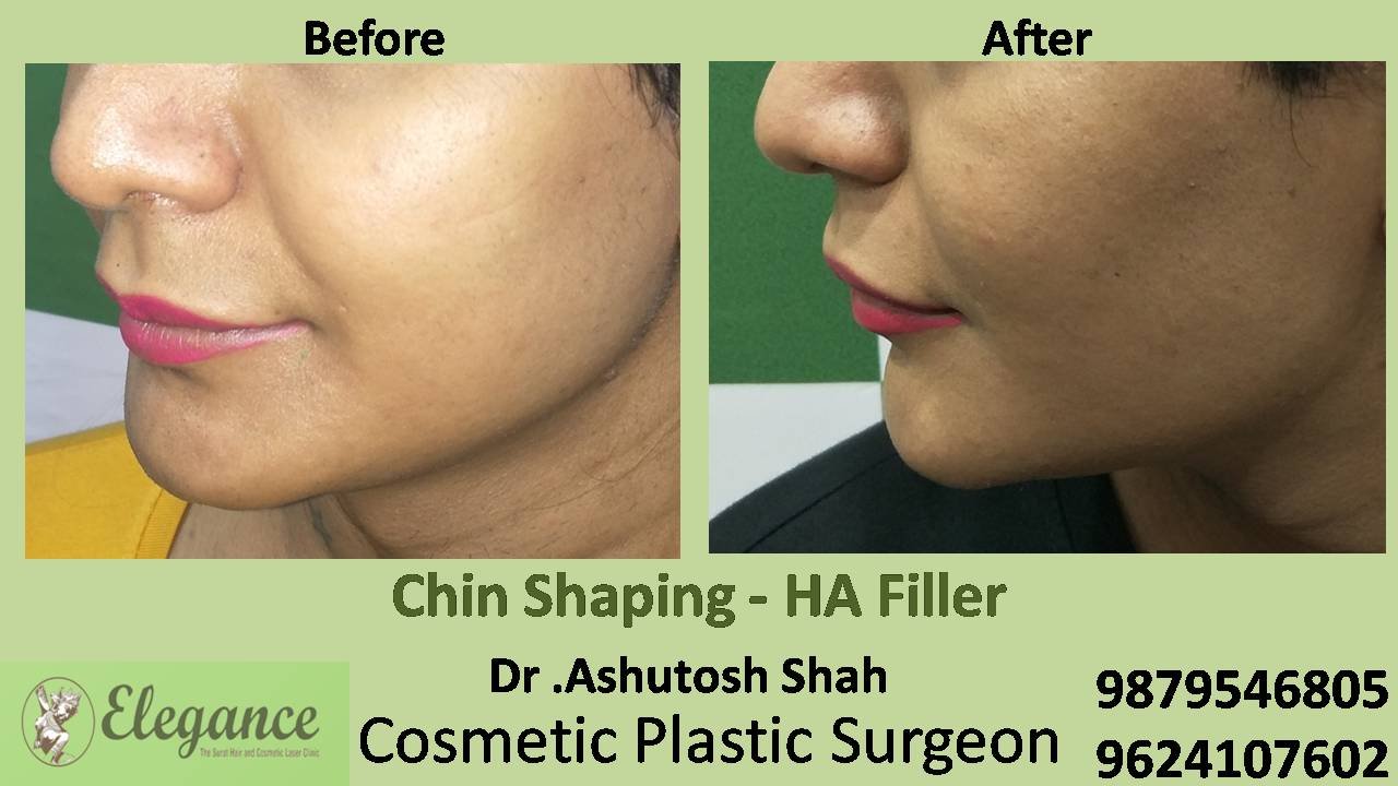 Chin Shaping Treatment in Surat, Gujarat, India.