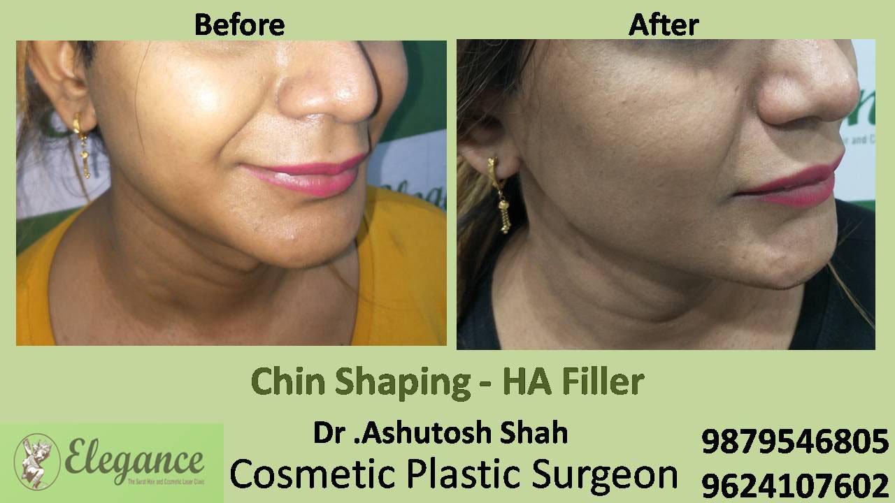 Chin Shaping Treatment in Vadodara, Gujarat, India.