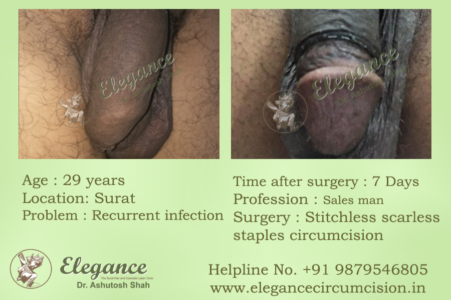 Circumcision Clinic in Surat, Gujarat, India