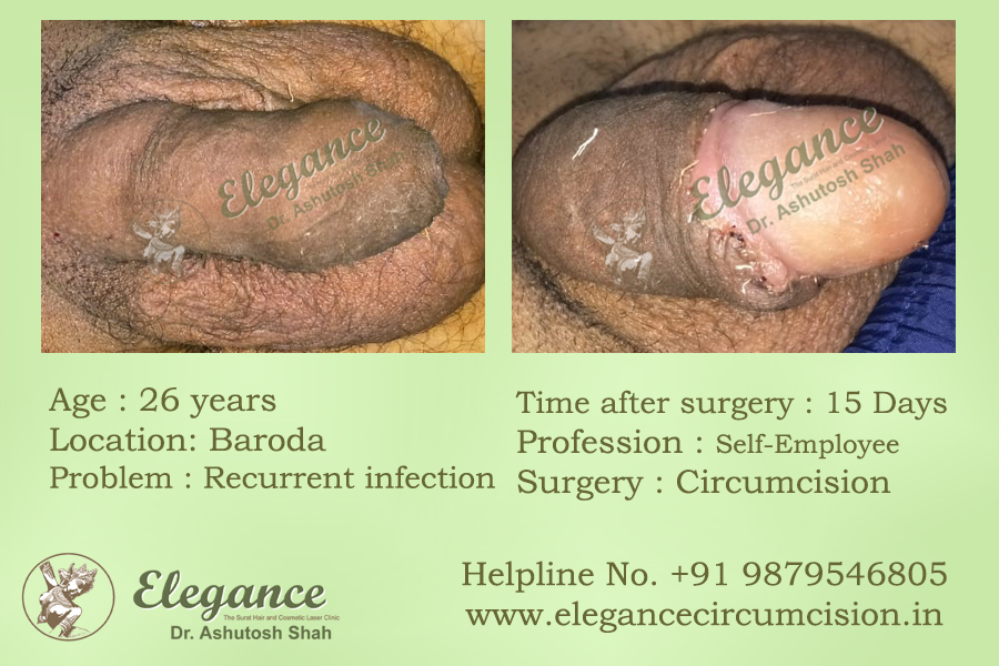Circumcision Surgery in Surat, Gujarat (India)