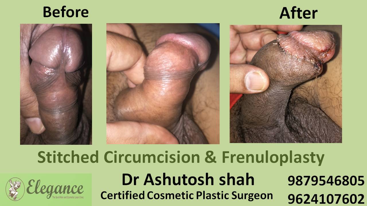 Stitched Circumcision Treatment in Surat, Gujarat