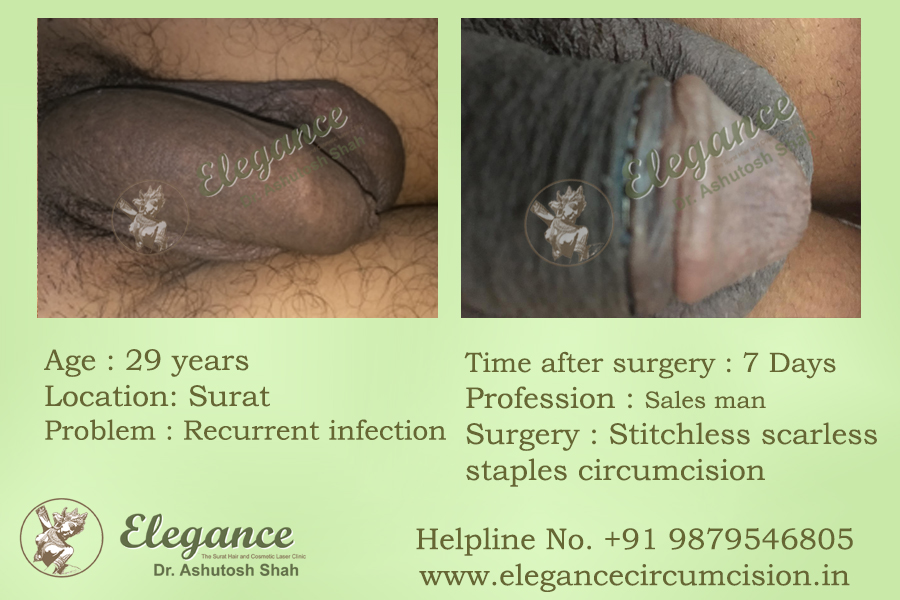Fue Circumcision Cost Surat, Gujarat, India