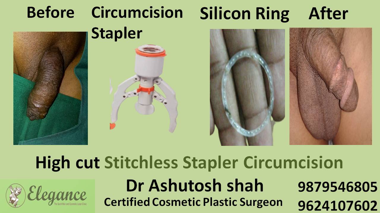 Stitchless Stapler Circumcision Pune, Maharashtra, India