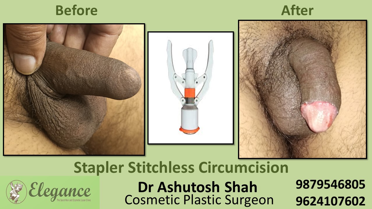 Best Circumcision Surgery Hospital in Surat,  Ankhleshwar, Vadodara, Mumbai, Nasik.