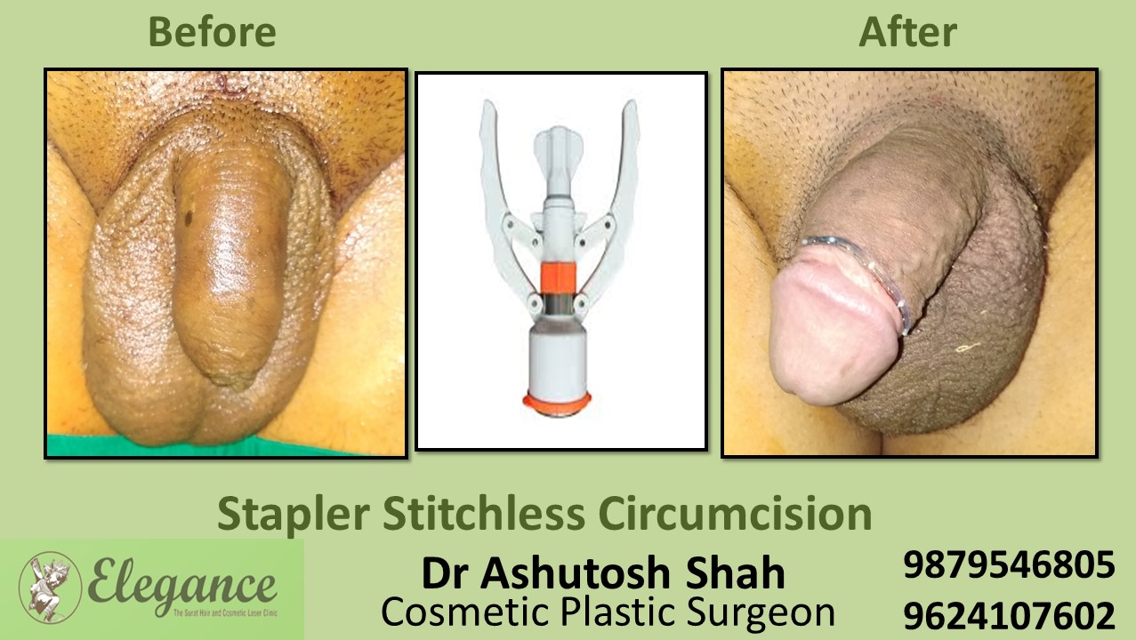 Circumcision Surgery In Surat, Bharuch, Vapi, Gujarat.