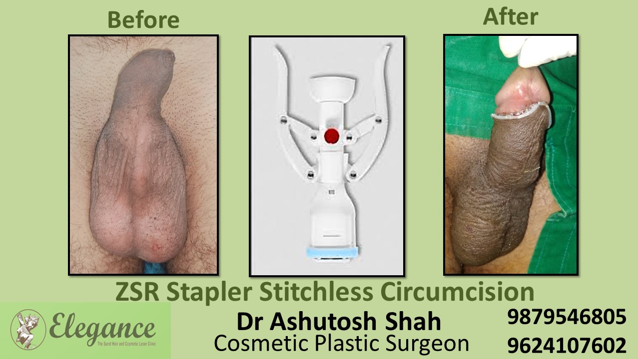 Circumcision Treatment In Surat, Vapi, Bharuch, Gujarat.