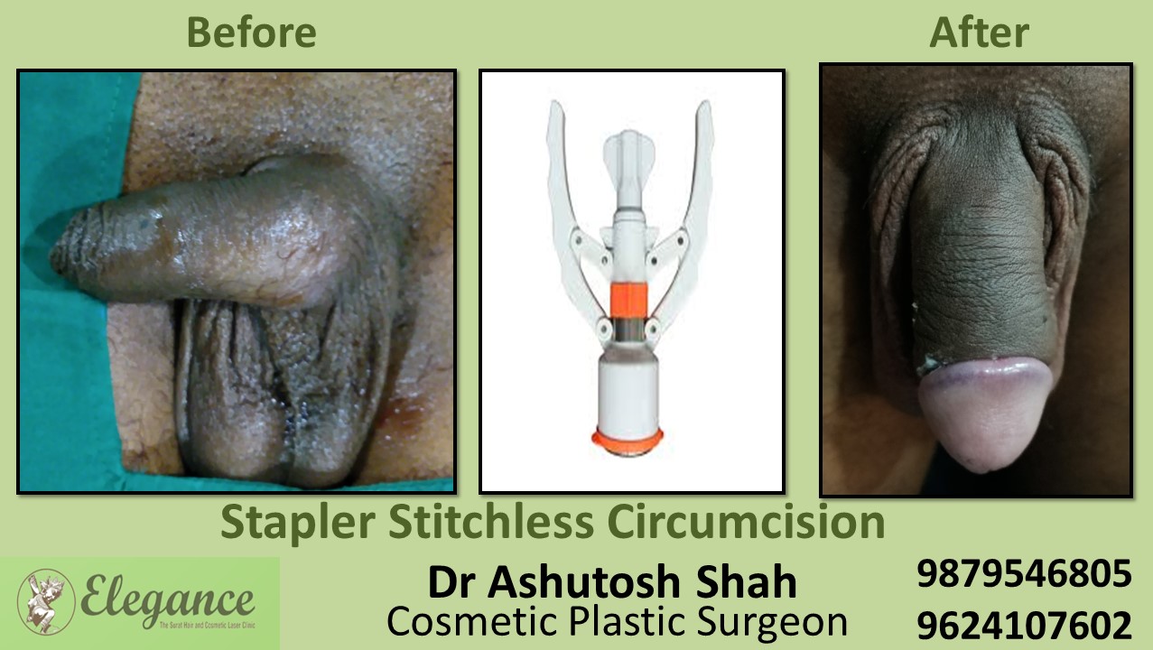 Low Cost Circumcision Treatment in  Ankhleshwar, Surat, Vadodara, Mumbai, Nasik.