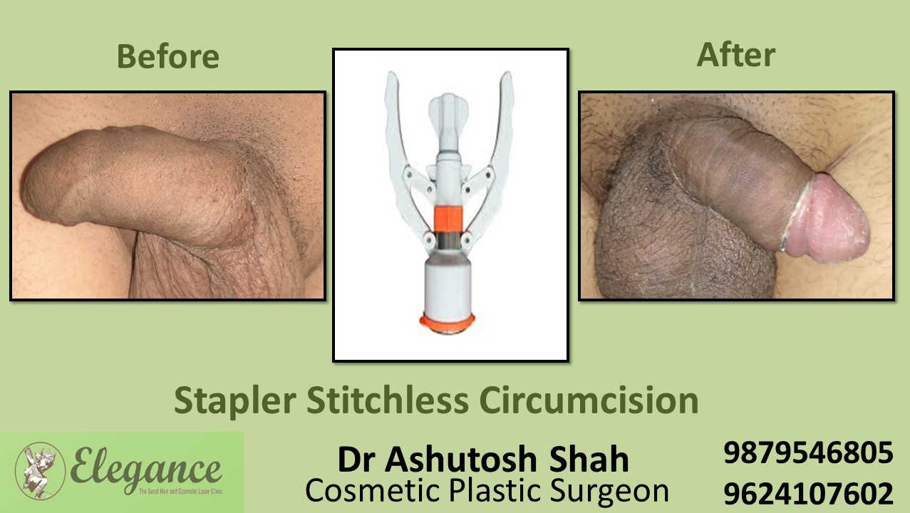 Stapler Circumcision In Surat Vapi, Bharuch, Gujarat