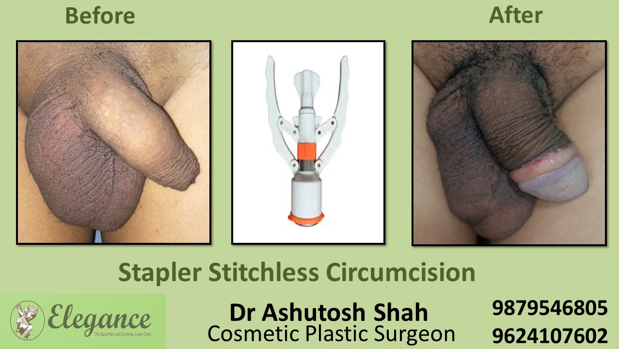 Stapler Stichless Circumcision  In Surat, Vapi, Bharuch, Gujarat.
