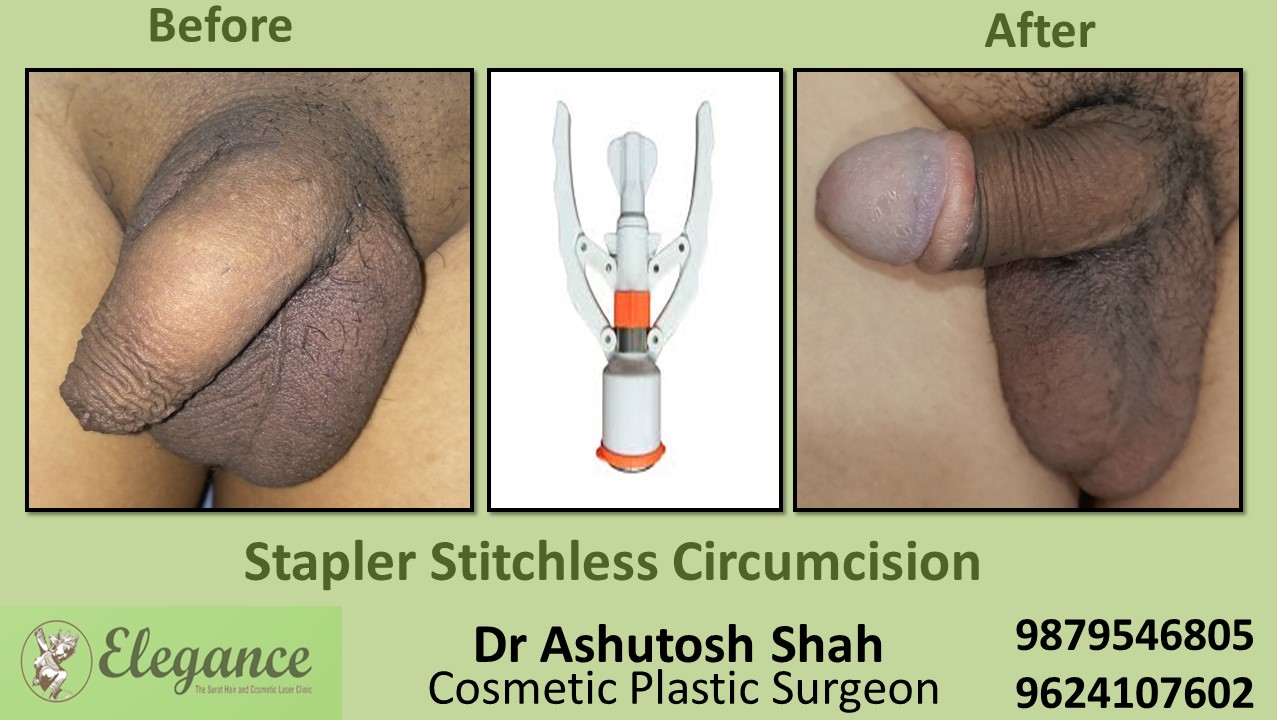 Stichless Stapler Circumcision , Scarless Treatment In Surat,Vapi,Gujarat