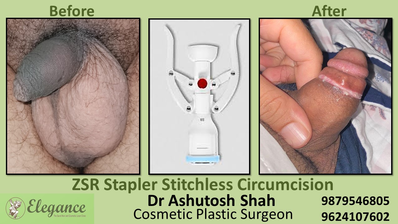 ZSR Circumcision Cosmetic Stitchless In Surat, Vapi, Bharuch,Gujarat.