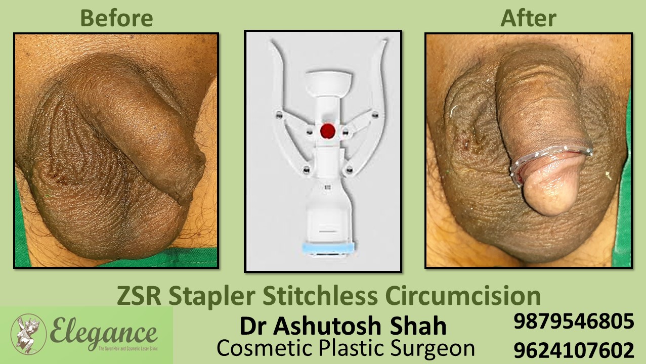 ZSR Circumcision ,Stichless Surgery In Surat, Vapi, Valsad, Gujarat