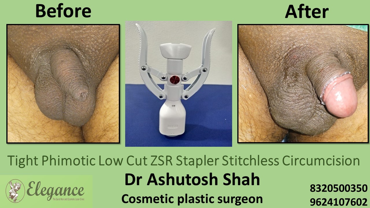 ZSR Stapler Stitchless Circumcision for tight phimosis in Bharuch, Surat, Gujarat