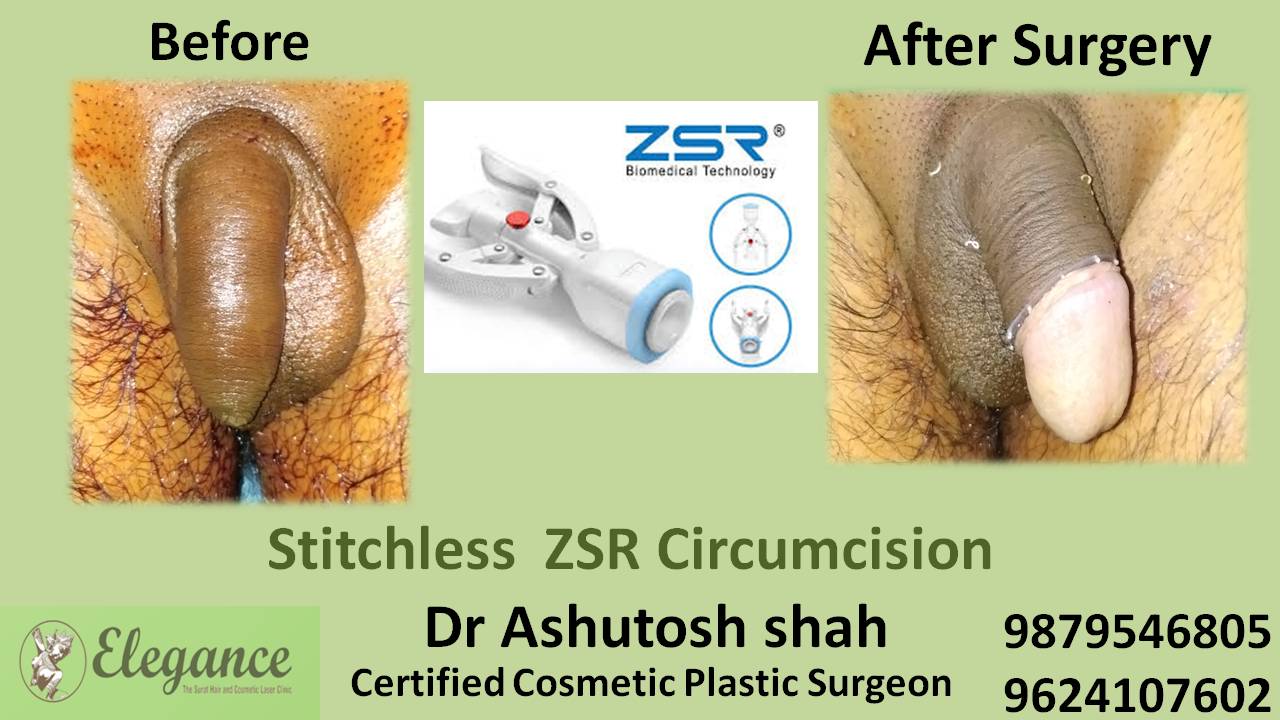 ZSR Stitchless Circumcision Surgery