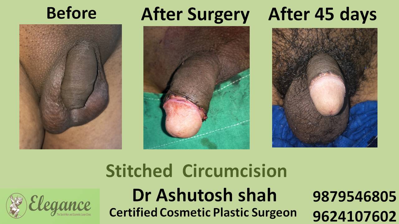 ZSR Stitchless Circumcision Surgery In Anand, Gujarat, India