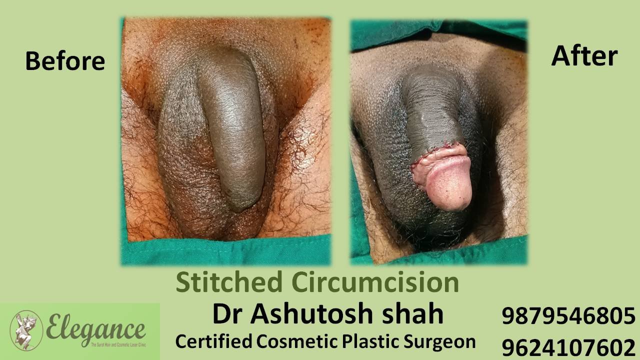 ZSR Stitchless Circumcision Surgery