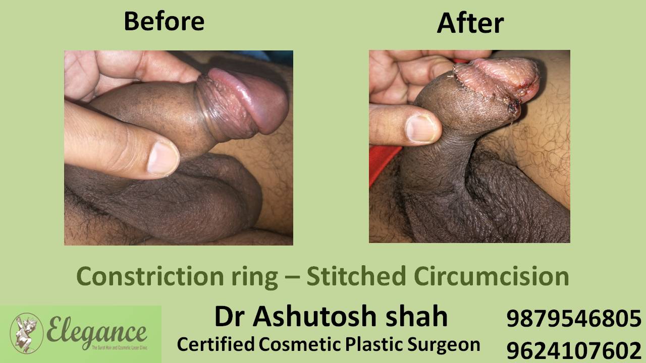 ZSR Stitchless Circumcision Surgery In Mumbai, Maharashtra, India