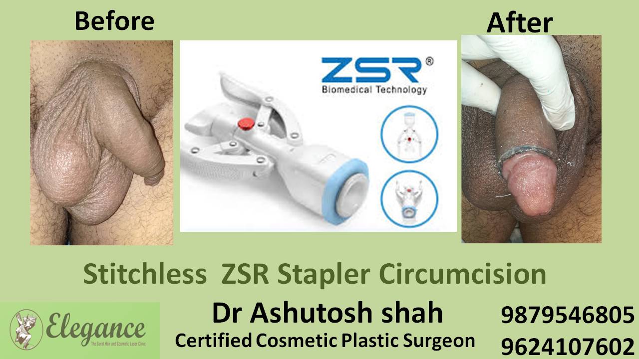 ZSR Stitchless Circumcision Surgery In Bharuch, Gujarat, India