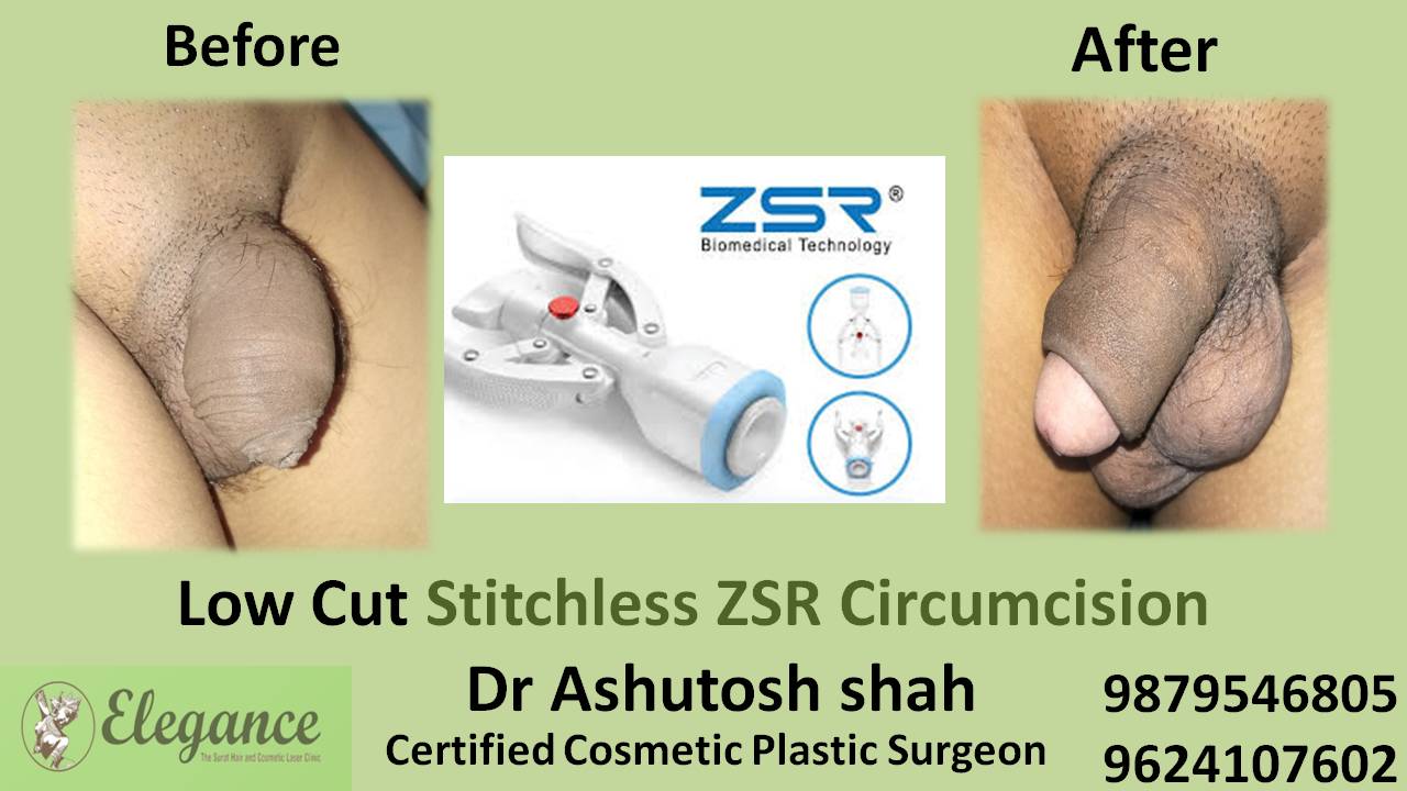 ZSR Stitchless Circumcision Surgery In Delhi, India