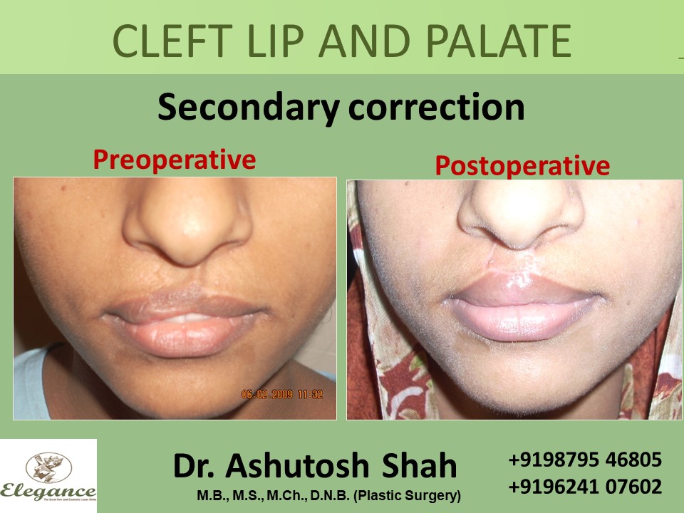 CLEFT LIP AND PALATE Treatment, Navsari, Gujarat, India.