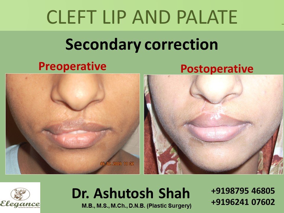 CLEFT LIP AND PALATE Treatment, Navsari, Gujarat, India.