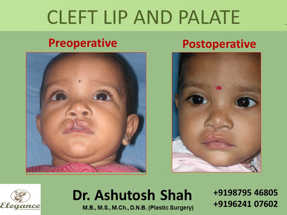 CLEFT LIP AND PALATE Treatment, Surat, Gujarat, India.