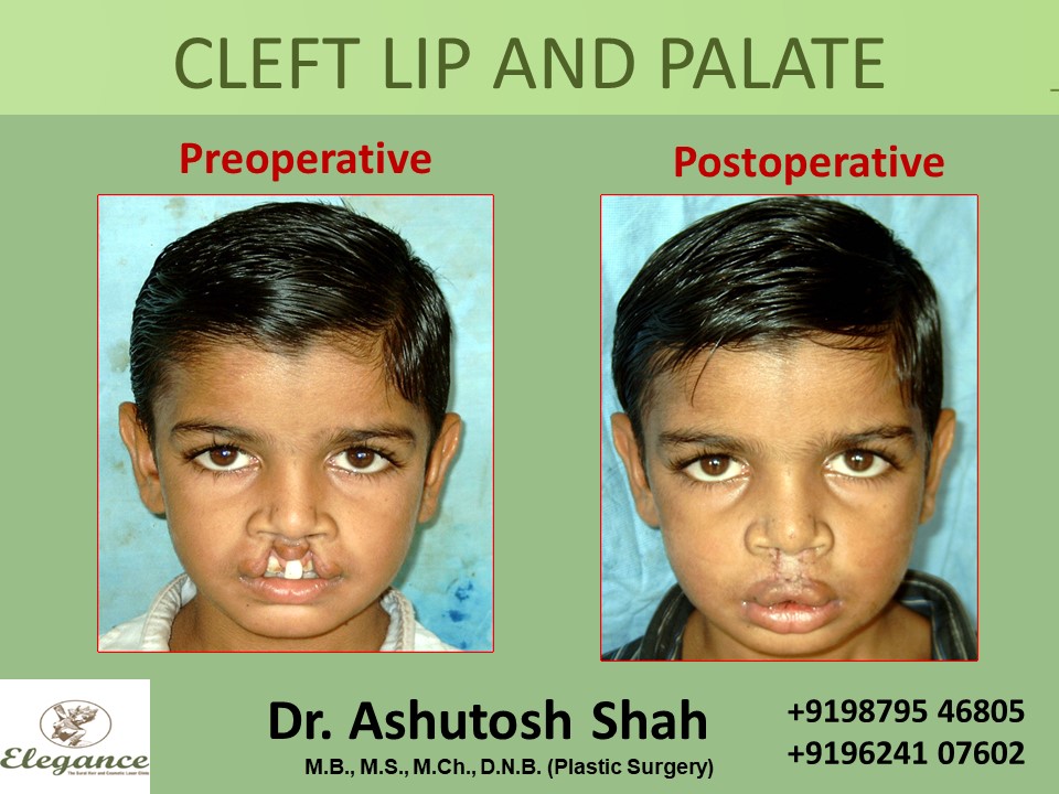 CLEFT LIP AND PALATE Treatment, Vadodara, Gujarat, India.